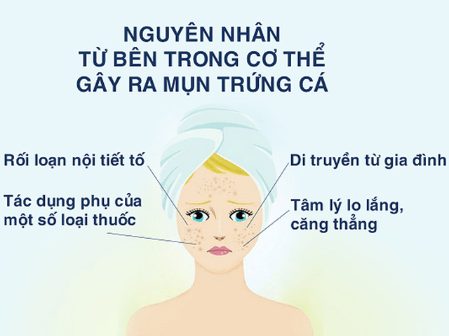 Chi tiết cách trị mụn trứng cá hiệu quả ngay tại nhà từ thể nhẹ tới nặng - Ảnh 3.