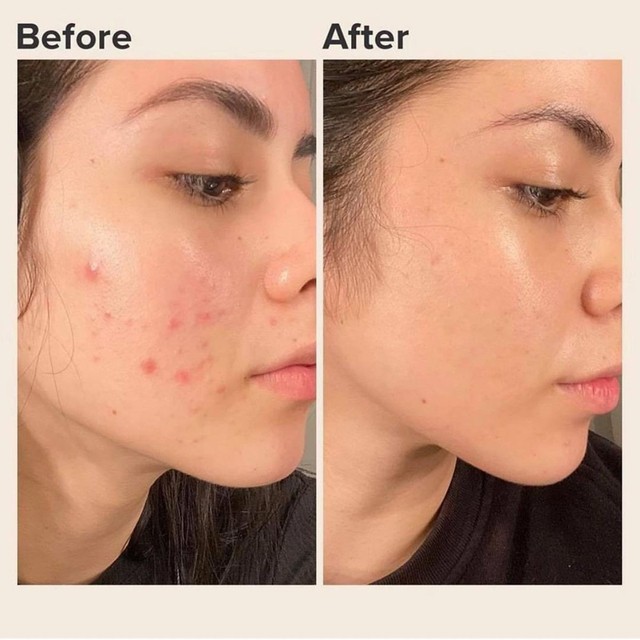 Trị mụn cấp tốc có thực sự an toàn? Lợi ích và tác hại bạn cần biết- Ảnh 2.