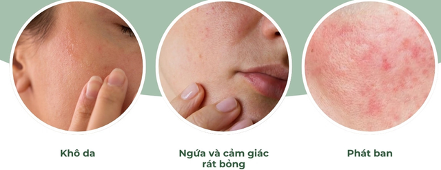 Trị mụn cấp tốc có thực sự an toàn? Lợi ích và tác hại bạn cần biết- Ảnh 4.