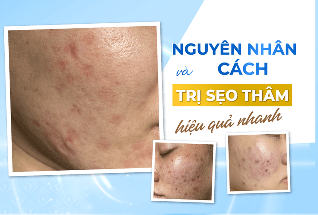 C&oacute; c&aacute;ch n&agrave;o trị th&acirc;m sẹo l&acirc;u năm hiệu quả tại nh&agrave;, tốn &iacute;t chi ph&iacute;?- Ảnh 3.