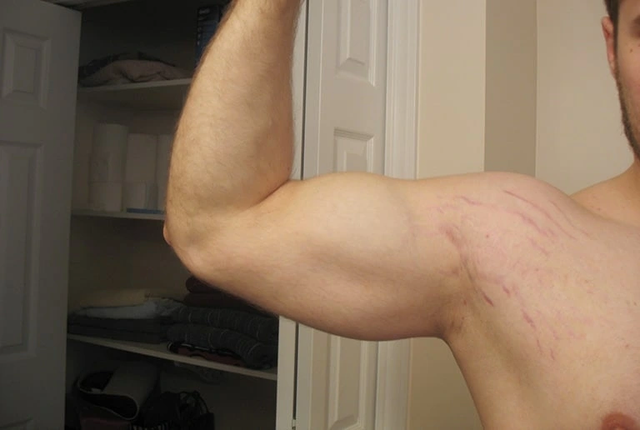 Rạn da không chỉ là chuyện của mẹ bầu!- Ảnh 4. Rạn da không chỉ là chuyện của mẹ bầu!- Ảnh 4.