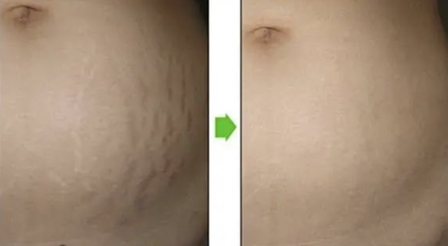 Rạn da không chỉ là chuyện của mẹ bầu!- Ảnh 9. Rạn da không chỉ là chuyện của mẹ bầu!- Ảnh 9.