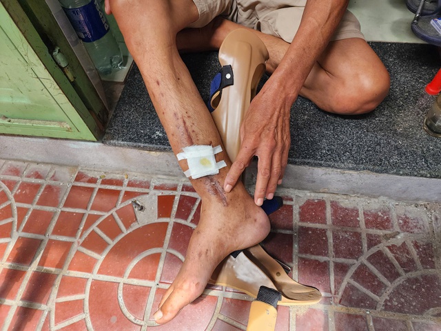Người đàn ông nghèo cầu cứu được cắt bỏ chân- Ảnh 3.