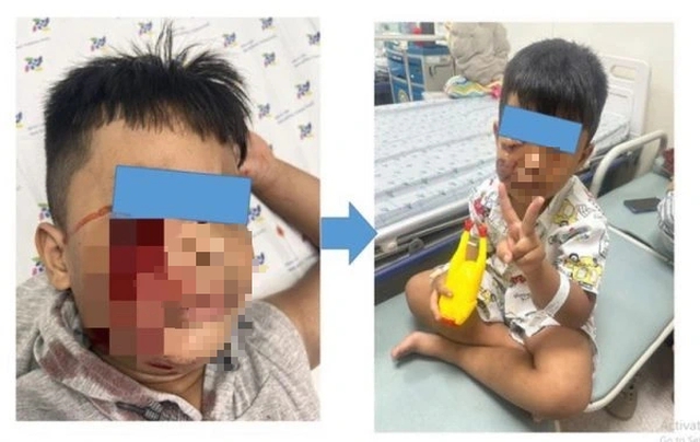 Đang chơi đùa, bé trai 5 tuổi bị chó cắn rách mặt - Ảnh 1.