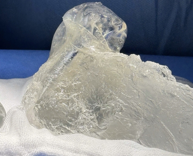 Th&aacute;o t&uacute;i ngực kh&ocirc;ng đau- Ảnh 1.