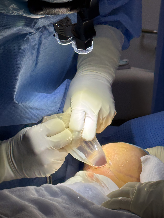 Th&aacute;o t&uacute;i ngực kh&ocirc;ng đau- Ảnh 2.