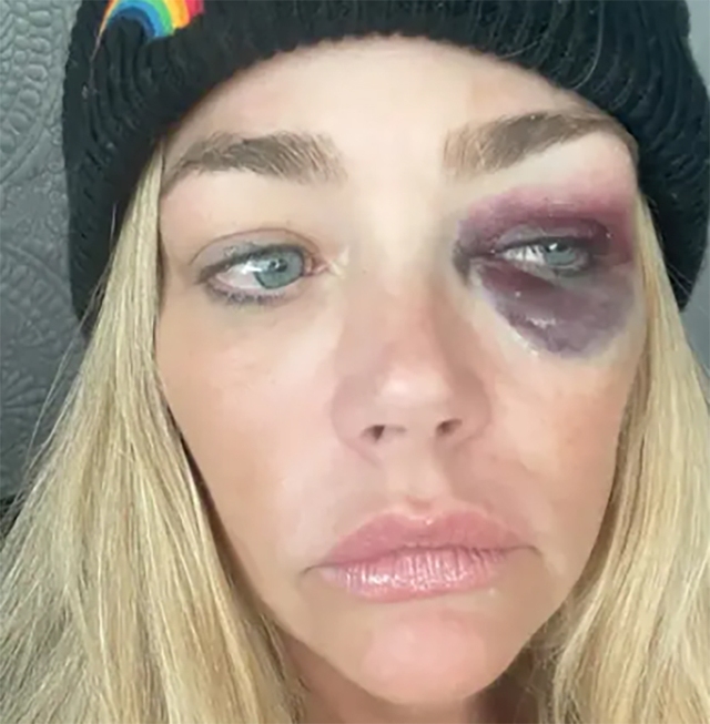 Nữ diễn viên Denise Richards bị chồng bạo hành nặng nề - Ảnh 2.