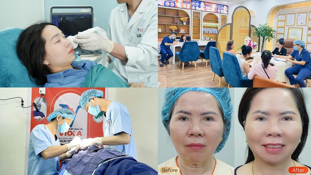 Căng da trẻ hóa khuôn mặt thời đại 4.0 tại Viện Thẩm mỹ Quốc tế Viola