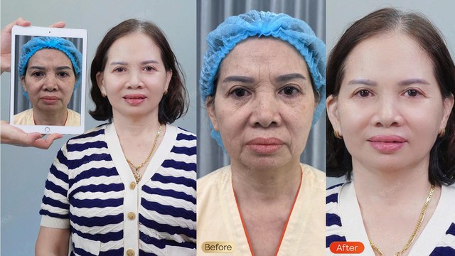 Căng da trẻ hóa khuôn mặt thời đại 4.0 tại Viện Thẩm mỹ Quốc tế Viola - Ảnh 3.