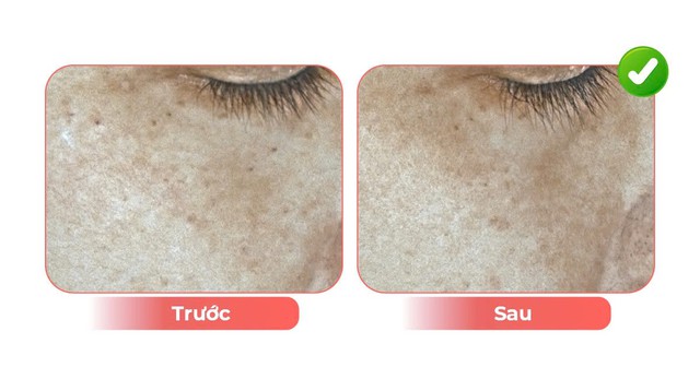 Hiệu quả khi trẻ h&oacute;a da bằng &aacute;nh s&aacute;ng tinh khiết- Ảnh 2.