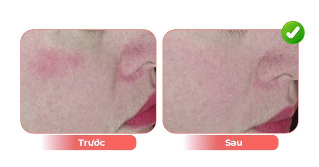 Hiệu quả khi trẻ h&oacute;a da bằng &aacute;nh s&aacute;ng tinh khiết- Ảnh 3.