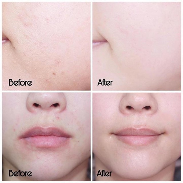 Top 5 kem dưỡng phục hồi sau trị mụn ai cũng 'm&ecirc;' ngay lần đầu ti&ecirc;n- Ảnh 1.