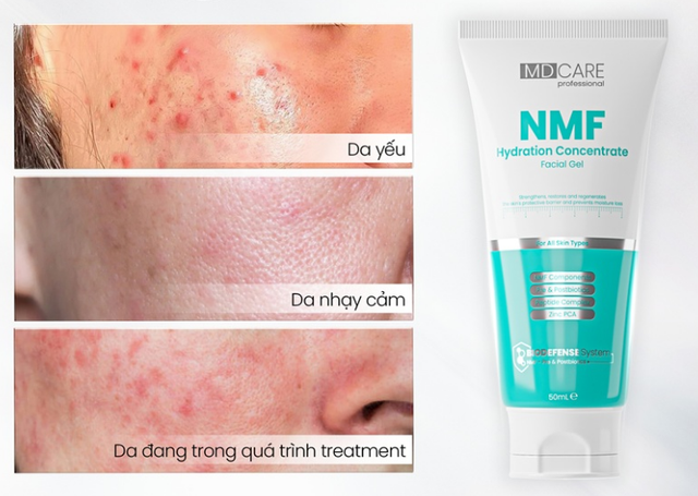 Top 5 kem dưỡng phục hồi sau trị mụn ai cũng 'm&ecirc;' ngay lần đầu ti&ecirc;n- Ảnh 4.