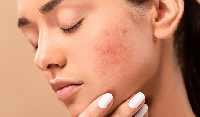 Da kích ứng vì thời tiết – Phục hồi như thế nào?