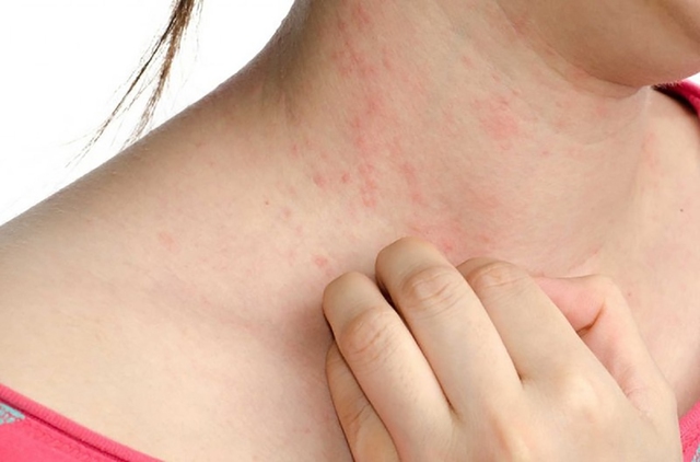 Da kích ứng vì thời tiết - Phục hồi như thế nào?- Ảnh 2.