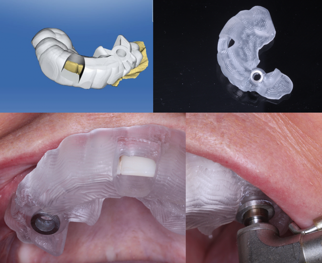 Ứng dụng 'GPS nha khoa' X-Guide: Bước tiến mới trong cấy ghép Implant- Ảnh 1. Ứng dụng 'GPS nha khoa' X-Guide: Bước tiến mới trong cấy ghép Implant- Ảnh 1.