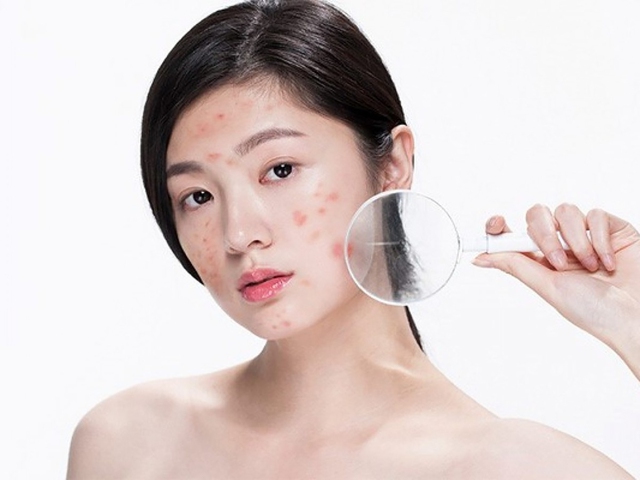 Bật mí cách trị thâm sau khi nặn mụn chuẩn y khoa hiệu quả ngay tại nhà- Ảnh 2. Bật mí cách trị thâm sau khi nặn mụn chuẩn y khoa hiệu quả ngay tại nhà- Ảnh 2.