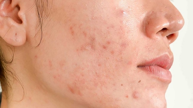 Bật mí cách trị thâm sau khi nặn mụn chuẩn y khoa hiệu quả ngay tại nhà- Ảnh 3. Bật mí cách trị thâm sau khi nặn mụn chuẩn y khoa hiệu quả ngay tại nhà- Ảnh 3.