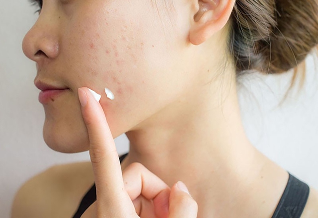 Bật mí cách trị thâm sau khi nặn mụn chuẩn y khoa hiệu quả ngay tại nhà- Ảnh 5. Bật mí cách trị thâm sau khi nặn mụn chuẩn y khoa hiệu quả ngay tại nhà- Ảnh 5.