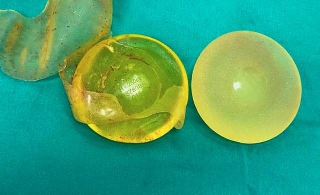 Người phụ nữ bị vỡ t&uacute;i ngực silicon sau 22 năm n&acirc;ng cấp v&ograve;ng 1 - Ảnh 1.