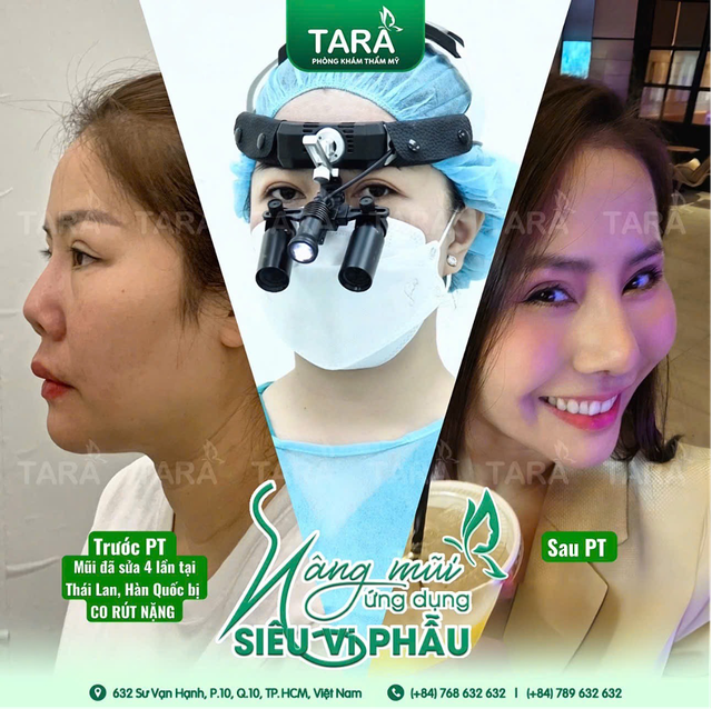 Sửa lại mũi hỏng nhanh lành với ứng dụng nâng mũi siêu vi phẫu Sửa lại mũi hỏng nhanh lành với ứng dụng nâng mũi siêu vi phẫu
