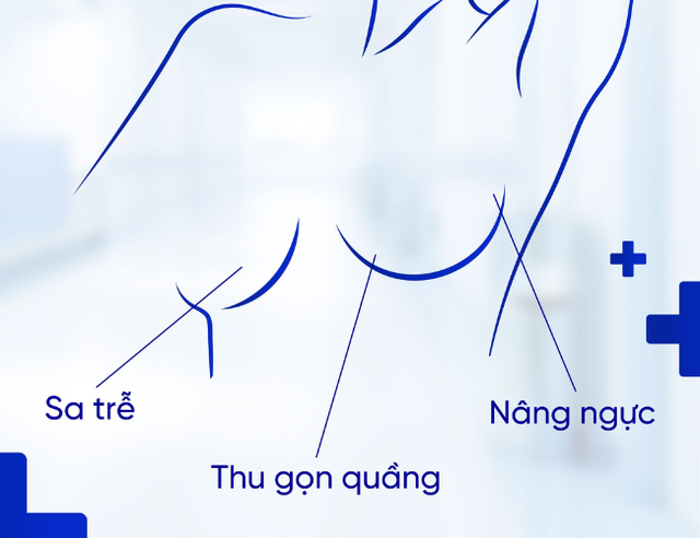 Những sai lầm cần tránh để có vết sẹo đẹp sau nâng ngực Những sai lầm cần tránh để có vết sẹo đẹp sau nâng ngực