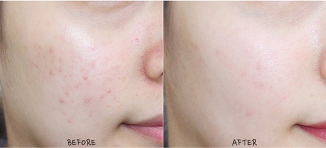 Top 4 sản phẩm trị mụn cấp tốc cho da nhạy cảm, dịu nhẹ không kích ứng - Ảnh 1.