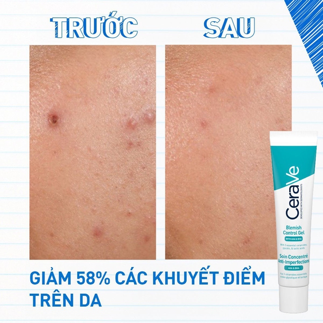 Top 4 sản phẩm trị mụn cấp tốc cho da nhạy cảm, dịu nhẹ không kích ứng - Ảnh 6.