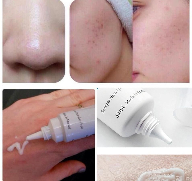 Top 4 sản phẩm trị mụn cấp tốc cho da nhạy cảm, dịu nhẹ không kích ứng - Ảnh 8.