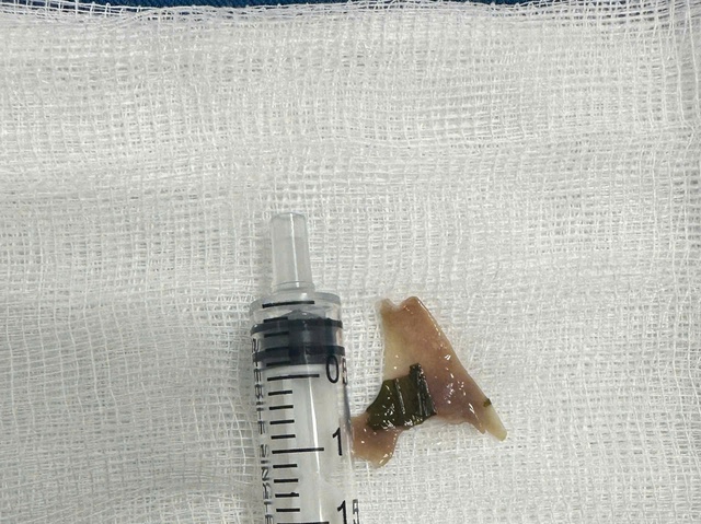 - Ảnh 1. Quảng Ngãi: Nội soi gắp xương vịt sắc nhọn ở thực quản, cứu bé trai 12 tuổi - Ảnh 1.