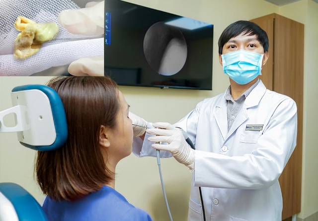 Miếng gạc bị 'bỏ quên' 1 tháng trong mũi sau phẫu thuật thẩm mỹ - Ảnh 1.