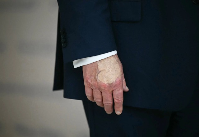 Dấu vết lạ trên mu bàn tay của Tổng thống Trump- Ảnh 1. Dấu vết lạ trên mu bàn tay của Tổng thống Trump- Ảnh 1.