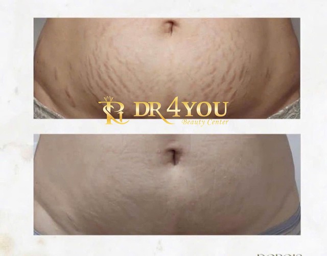 Kh&aacute;m ph&aacute; 7 lợi &iacute;ch tuyệt vời của c&ocirc;ng nghệ Plasma Lạnh trong thẩm mỹ - Ảnh 5.