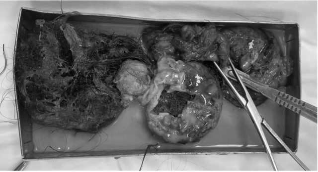 TP.HCM: Cứu nữ bệnh nhân vỡ u quái buồng trứng, răng và tóc tràn ra ổ bụng - Ảnh 1. TP.HCM: Cứu nữ bệnh nhân vỡ u quái buồng trứng, răng và tóc tràn ra ổ bụng - Ảnh 1.