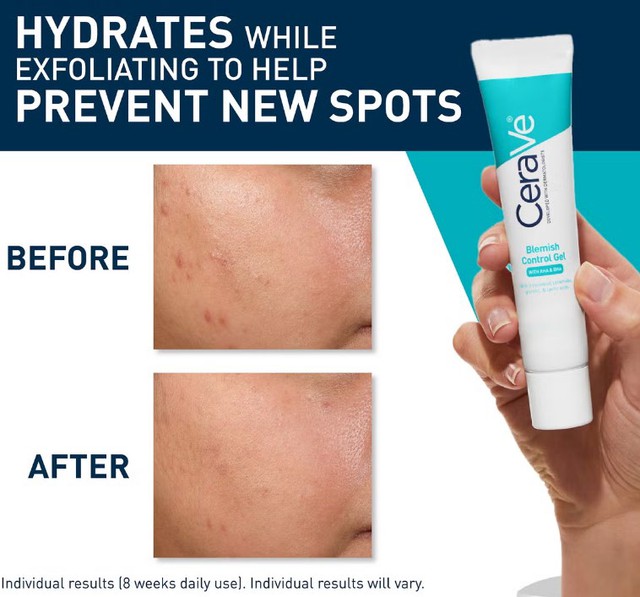 Top 12 kem trị mụn dứt điểm cả mụn thể nặng mà không thâm, không kích ứng - Ảnh 3.