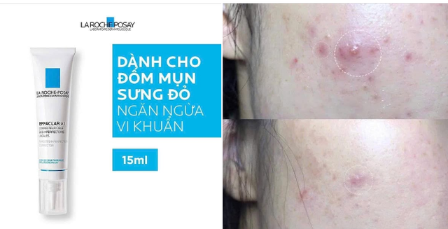 Top 5 kem giảm mụn vi&ecirc;m sưng xẹp nhanh, ngăn t&aacute;i ph&aacute;t v&agrave; ngừa sẹo hiệu quả- Ảnh 8.