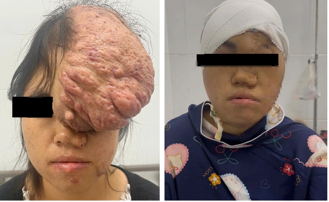 Cô gái Sơn La mang khối u sọ 15 năm được mổ thành công ở Bình Dương - Ảnh 1.