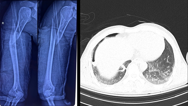 Tưởng Như Mất Cánh Tay Sau Tai Nạn, Nam Thanh Niên 26 Tuổi Hồi Phục Ngoạn Mục- Ảnh 1. Tưởng Như Mất Cánh Tay Sau Tai Nạn, Nam Thanh Niên 26 Tuổi Hồi Phục Ngoạn Mục- Ảnh 1.