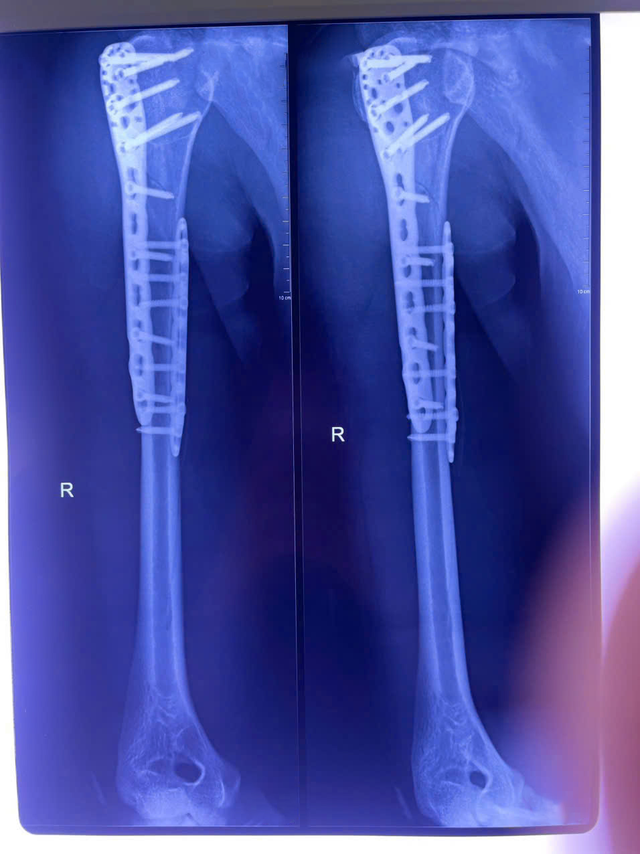 Tưởng Như Mất Cánh Tay Sau Tai Nạn, Nam Thanh Niên 26 Tuổi Hồi Phục Ngoạn Mục- Ảnh 2. Tưởng Như Mất Cánh Tay Sau Tai Nạn, Nam Thanh Niên 26 Tuổi Hồi Phục Ngoạn Mục- Ảnh 2.