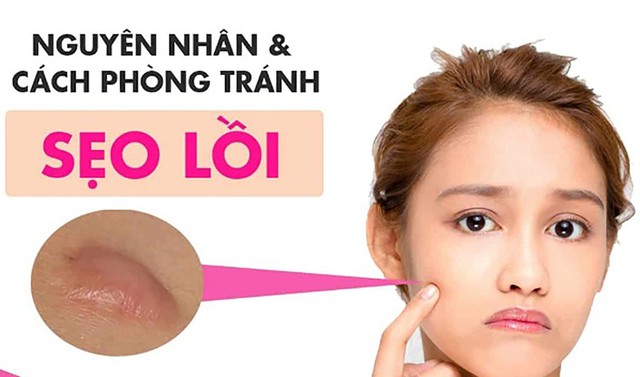 Sẹo lồi: Nguy&ecirc;n nh&acirc;n v&agrave; c&aacute;ch điều trị với cả sẹo l&acirc;u năm, ngừa t&aacute;i ph&aacute;t - Ảnh 1.