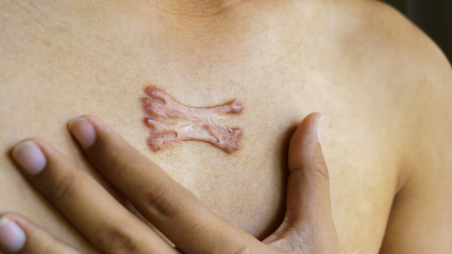 Sẹo lồi: Nguy&ecirc;n nh&acirc;n v&agrave; c&aacute;ch điều trị với cả sẹo l&acirc;u năm, ngừa t&aacute;i ph&aacute;t - Ảnh 3.