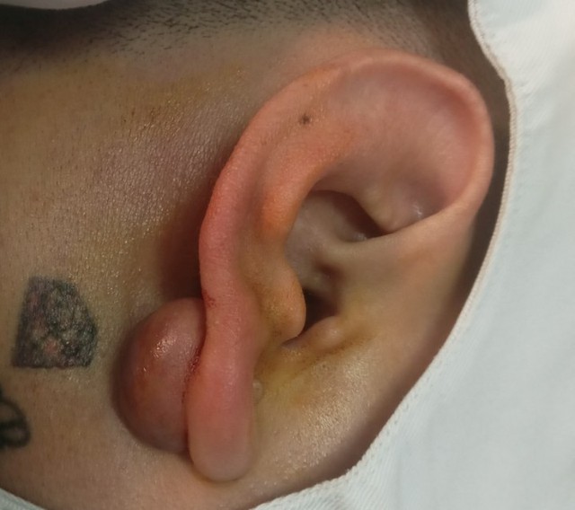 Sẹo lồi: Nguy&ecirc;n nh&acirc;n v&agrave; c&aacute;ch điều trị với cả sẹo l&acirc;u năm, ngừa t&aacute;i ph&aacute;t - Ảnh 4.