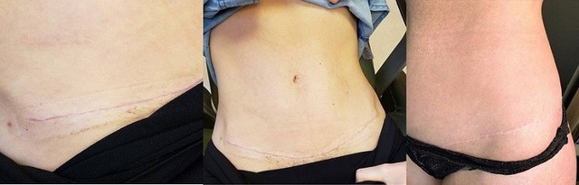 Sẹo lồi: Nguy&ecirc;n nh&acirc;n v&agrave; c&aacute;ch điều trị với cả sẹo l&acirc;u năm, ngừa t&aacute;i ph&aacute;t - Ảnh 6.