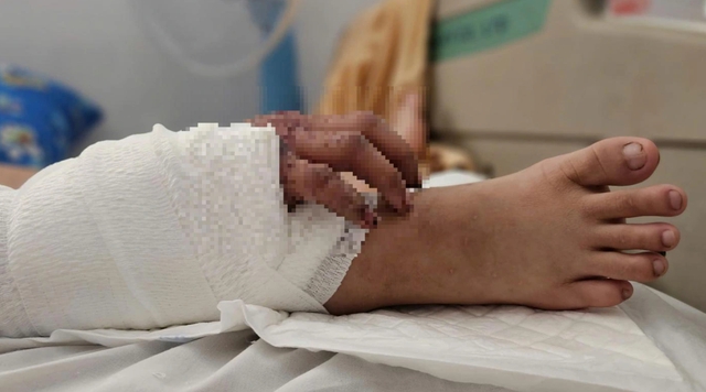 TP.HCM: Phẫu thuật ghép bàn tay vào chân thành công cho bệnh nhân trẻ mang song thai - Ảnh 4.