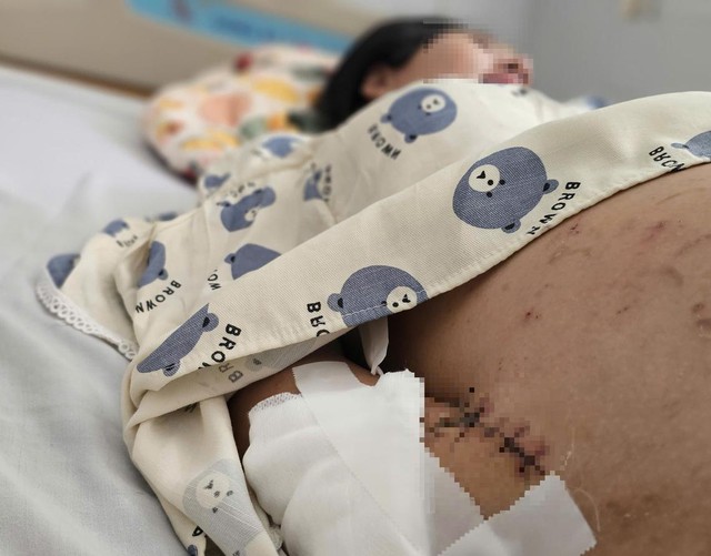 TP.HCM: Phẫu thuật ghép bàn tay vào chân thành công cho bệnh nhân trẻ mang song thai - Ảnh 5.