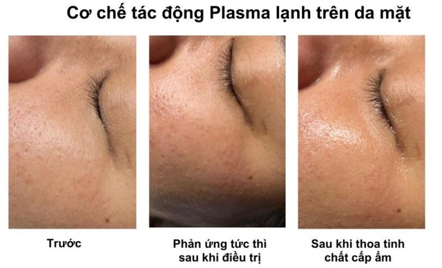 Hướng dẫn sử dụng máy Plasma Gold trong làm đẹp trị sẹo hiệu quả tối ưu - Ảnh 11. Hướng dẫn sử dụng máy Plasma Gold trong làm đẹp trị sẹo hiệu quả tối ưu - Ảnh 11.