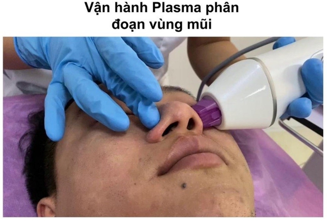 Hướng dẫn sử dụng máy Plasma Gold trong làm đẹp trị sẹo hiệu quả tối ưu - Ảnh 15. Hướng dẫn sử dụng máy Plasma Gold trong làm đẹp trị sẹo hiệu quả tối ưu - Ảnh 15.