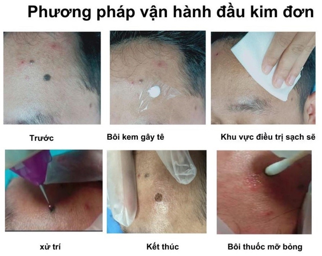 Hướng dẫn sử dụng máy Plasma Gold trong làm đẹp trị sẹo hiệu quả tối ưu - Ảnh 18. Hướng dẫn sử dụng máy Plasma Gold trong làm đẹp trị sẹo hiệu quả tối ưu - Ảnh 18.