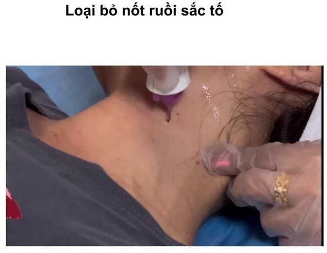 Hướng dẫn sử dụng máy Plasma Gold trong làm đẹp trị sẹo hiệu quả tối ưu - Ảnh 19. Hướng dẫn sử dụng máy Plasma Gold trong làm đẹp trị sẹo hiệu quả tối ưu - Ảnh 19.