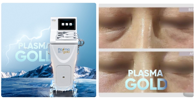 Hướng dẫn sử dụng máy Plasma Gold trong làm đẹp trị sẹo hiệu quả tối ưu - Ảnh 20. Hướng dẫn sử dụng máy Plasma Gold trong làm đẹp trị sẹo hiệu quả tối ưu - Ảnh 20.